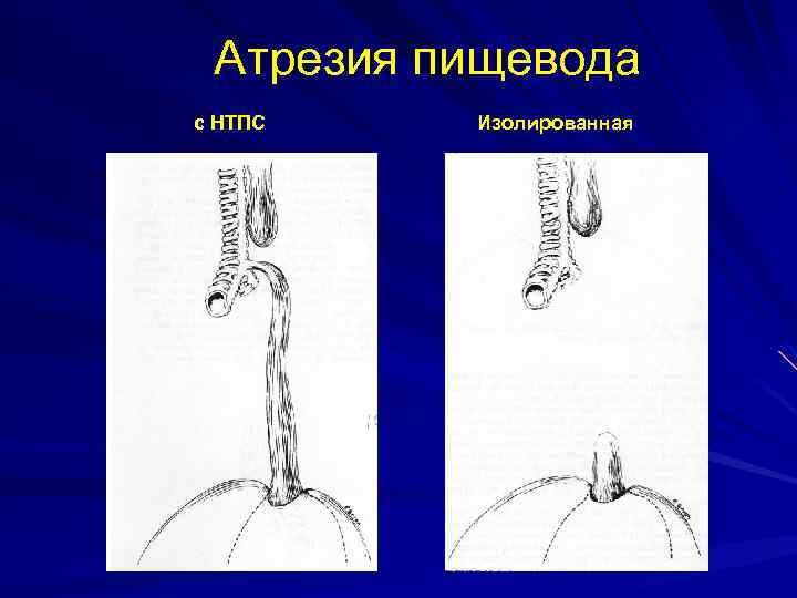Атрезия пищевода с НТПС Изолированная рр рр 