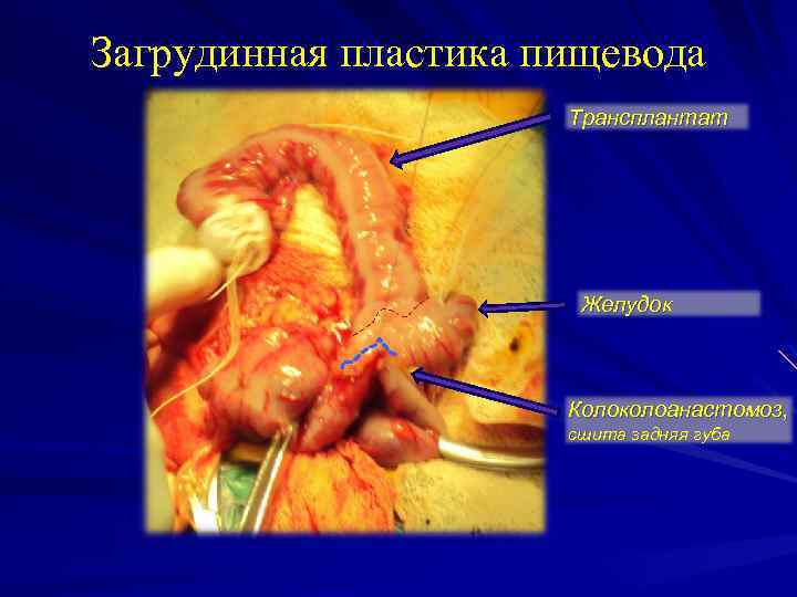 Загрудинная пластика пищевода Трансплантат Желудок Колоколоанастомоз, сшита задняя губа 