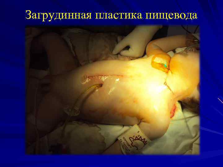 Загрудинная пластика пищевода 