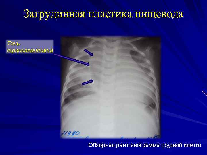Загрудинная пластика пищевода Тень трансплантата Обзорная рентгенограмма грудной клетки 