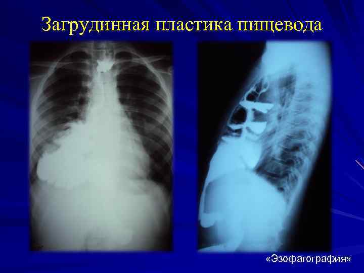 Загрудинная пластика пищевода «Эзофагография» 