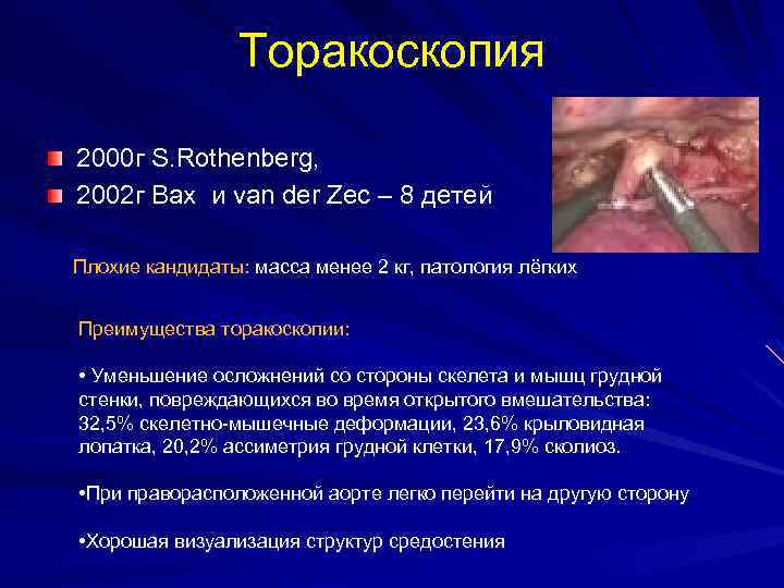 Торакоскопия 2000 г S. Rothenberg, 2002 г Bax и van der Zec – 8