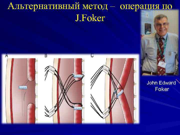 Альтернативный метод – операция по J. Foker John Edward Foker 