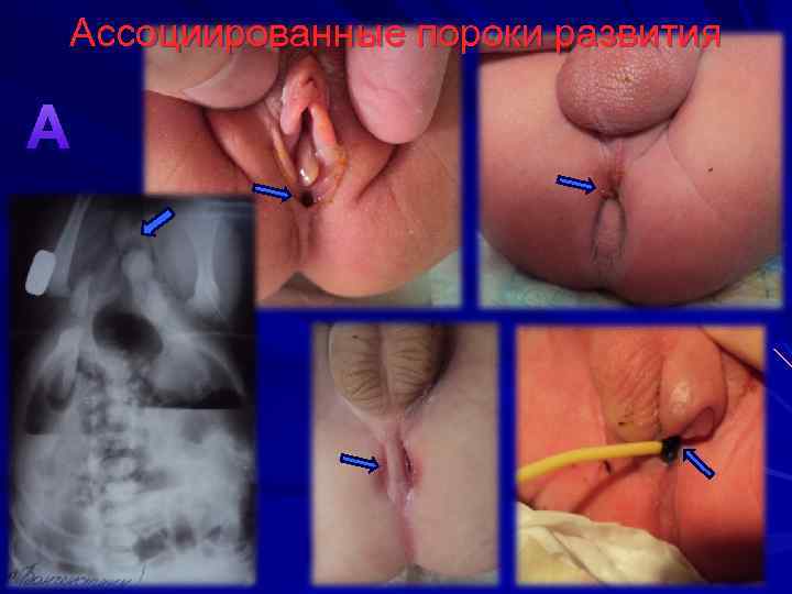 Ассоциированные пороки развития A 