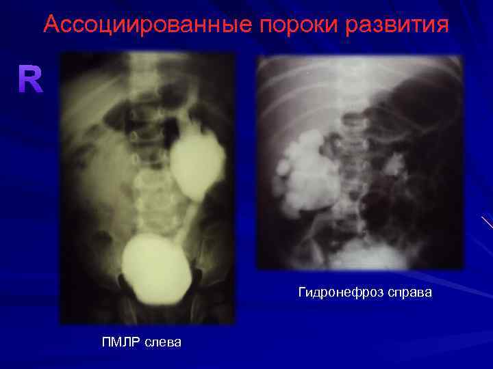 Ассоциированные пороки развития R Гидронефроз справа ПМЛР слева 