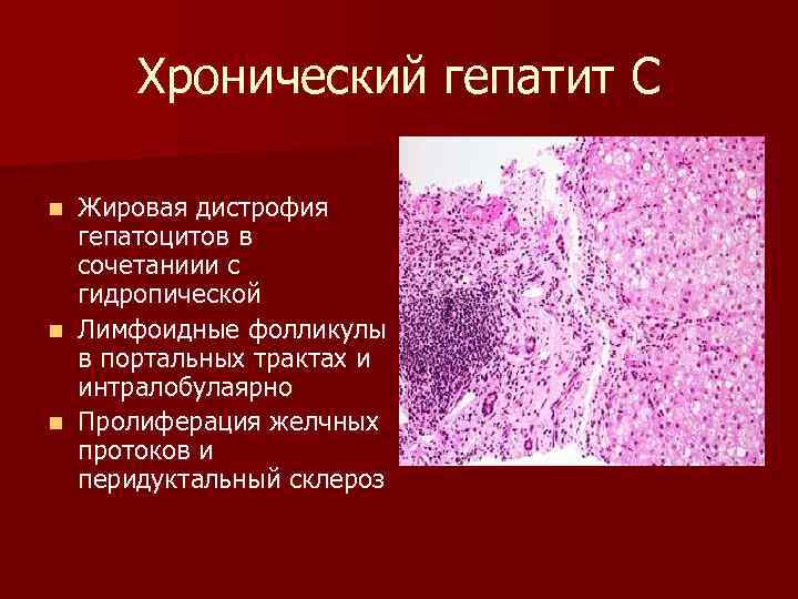 Что такое жировая дегенерация печени. Гидропическая дистрофия печени. Жировая дистрофия печени гепатоциты. Гидропическая дистрофия гепатоцитов гистология.