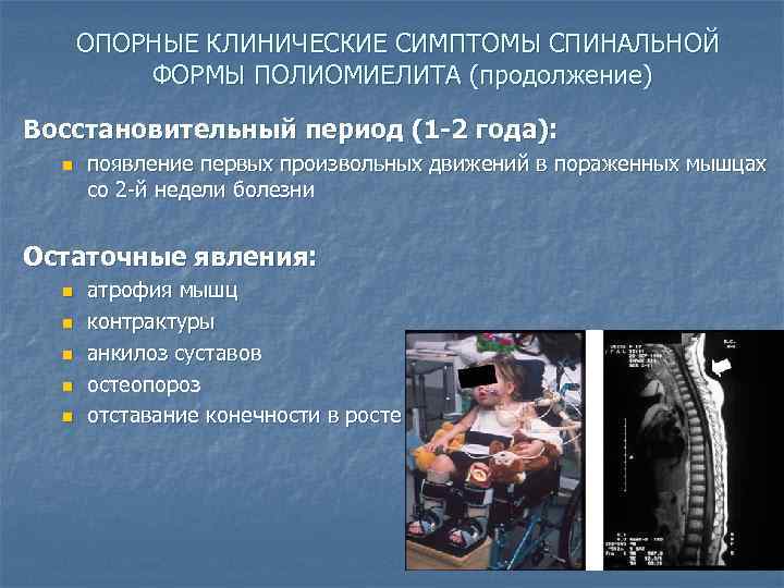 ОПОРНЫЕ КЛИНИЧЕСКИЕ СИМПТОМЫ СПИНАЛЬНОЙ ФОРМЫ ПОЛИОМИЕЛИТА (продолжение) Восстановительный период (1 -2 года): n появление