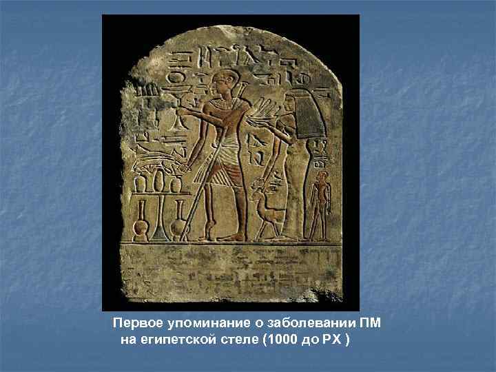 Первое упоминание о заболевании ПМ на египетской стеле (1000 до РХ ) 