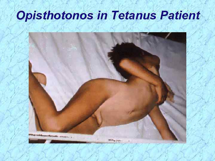 Opisthotonos in Tetanus Patient 