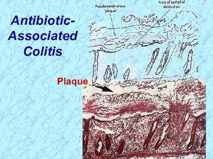 Antibiotic. Associated Colitis Plaque 