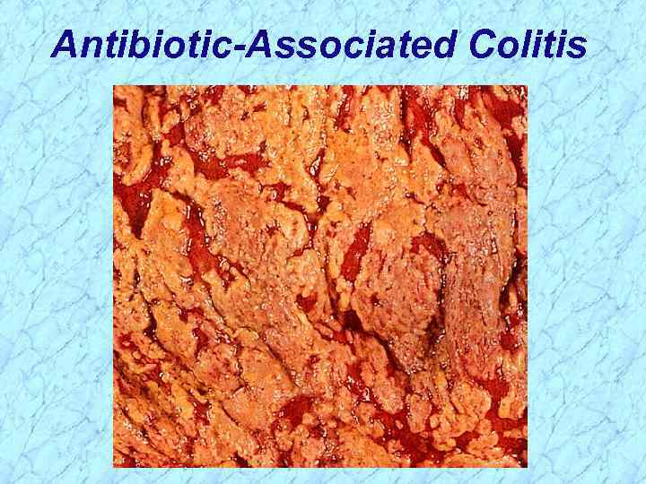 Antibiotic-Associated Colitis 