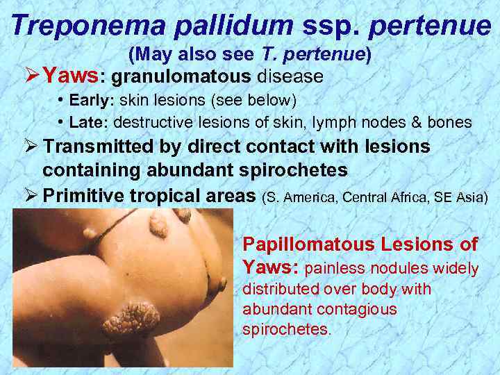 Treponema pallidum ssp. pertenue (May also see T. pertenue) Ø Yaws: granulomatous disease •