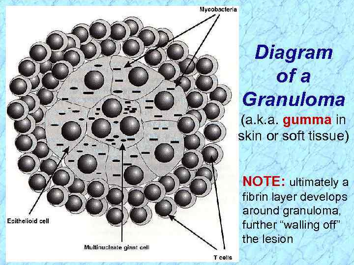 Diagram of a Granuloma (a. k. a. gumma in skin or soft tissue) NOTE: