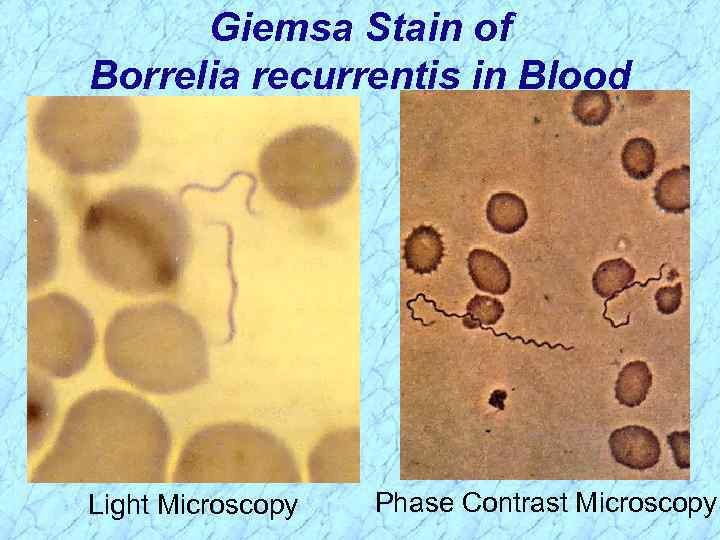 Giemsa Stain of Borrelia recurrentis in Blood Light Microscopy Phase Contrast Microscopy 