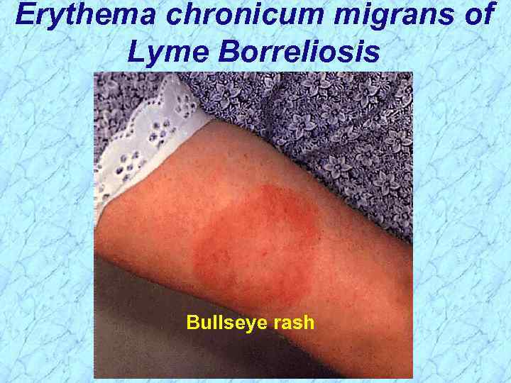 Erythema chronicum migrans of Lyme Borreliosis Bullseye rash 