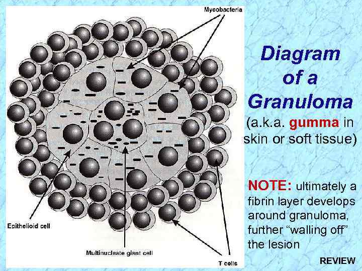 Diagram of a Granuloma (a. k. a. gumma in skin or soft tissue) NOTE: