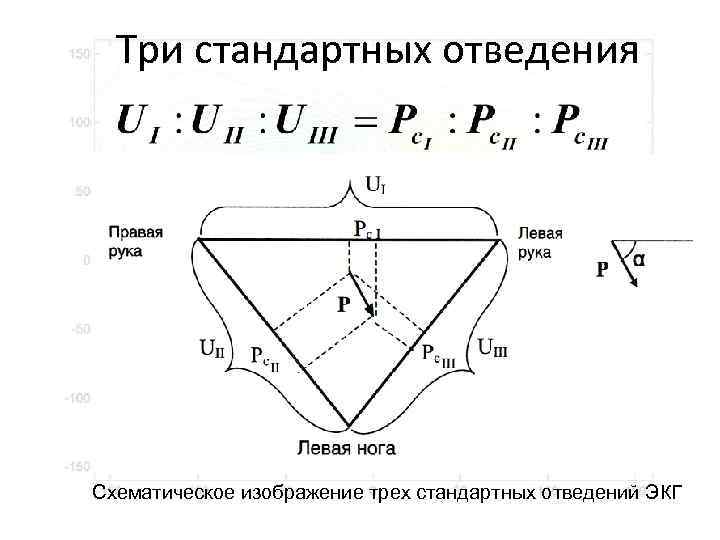 Три стандартных отведения Схематическое изображение трех стандартных отведений ЭКГ 