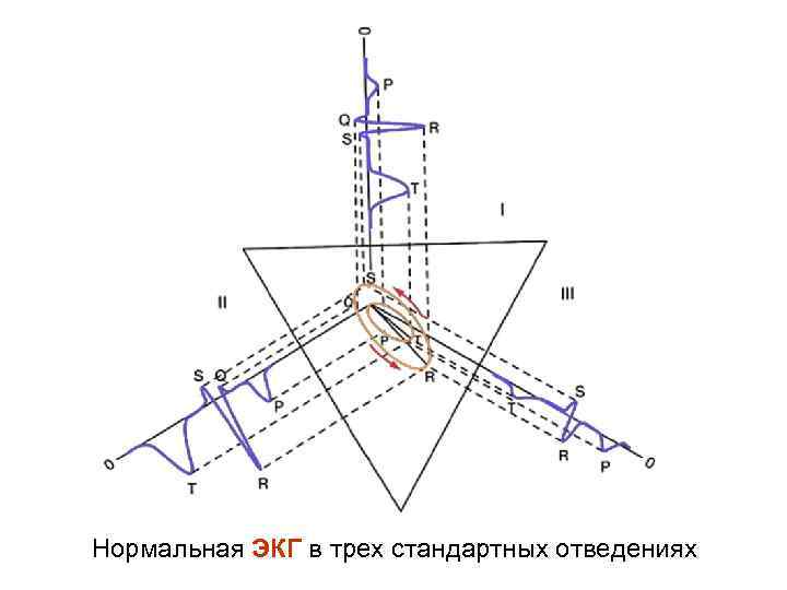 Нормальная ЭКГ в трех стандартных отведениях 