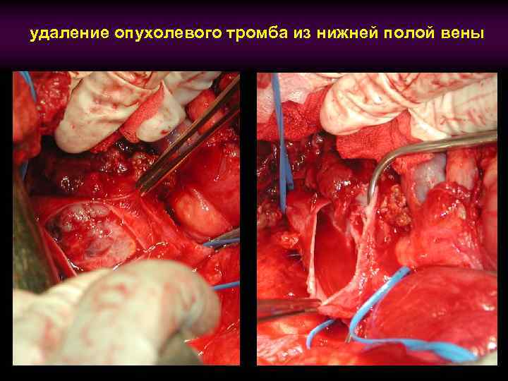 удаление опухолевого тромба из нижней полой вены 
