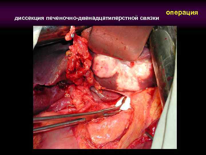 диссекция печеночно-двенадцатиперстной связки операция 