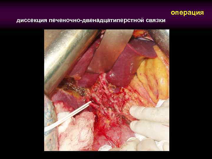 операция диссекция печеночно-двенадцатиперстной связки 