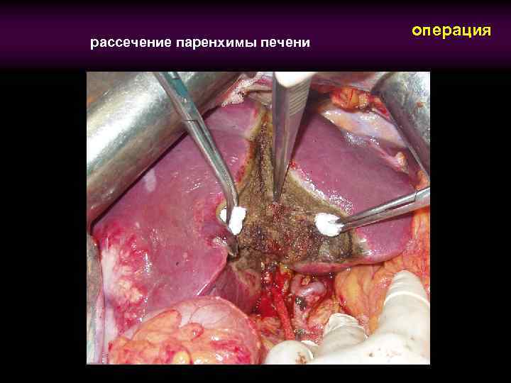 рассечение паренхимы печени операция 