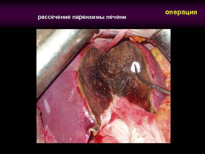 рассечение паренхимы печени операция 