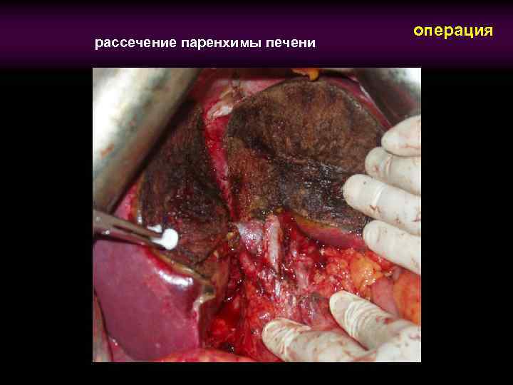 рассечение паренхимы печени операция 