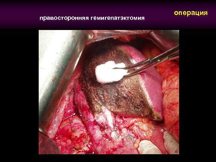 правосторонняя гемигепатэктомия операция 