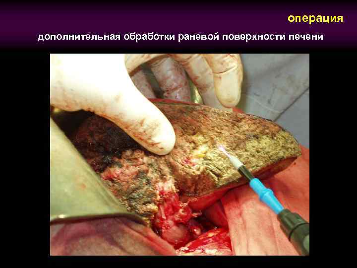 операция дополнительная обработки раневой поверхности печени 