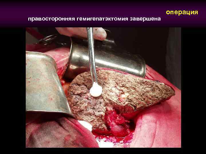правосторонняя гемигепатэктомия завершена операция 