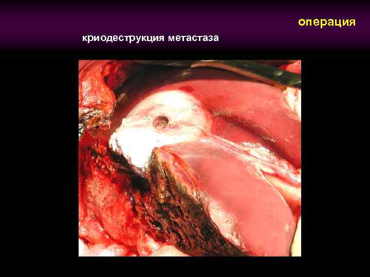 операция криодеструкция метастаза 