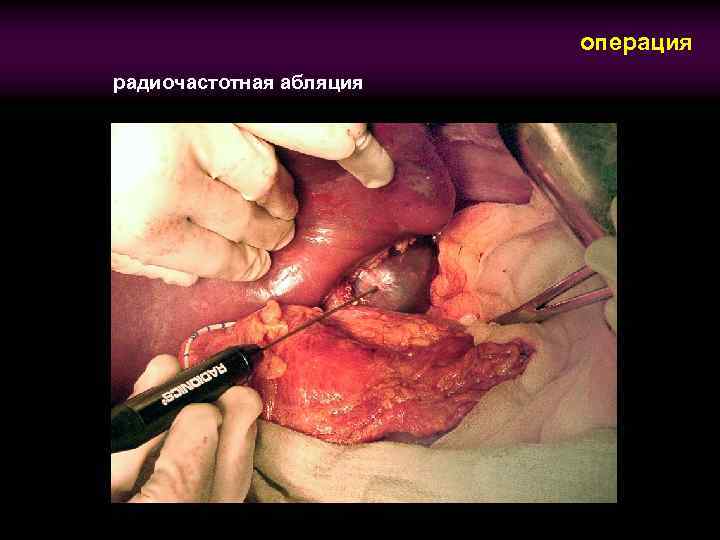 операция радиочастотная абляция 