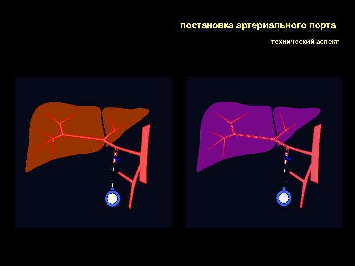 постановка артериального порта технический аспект 