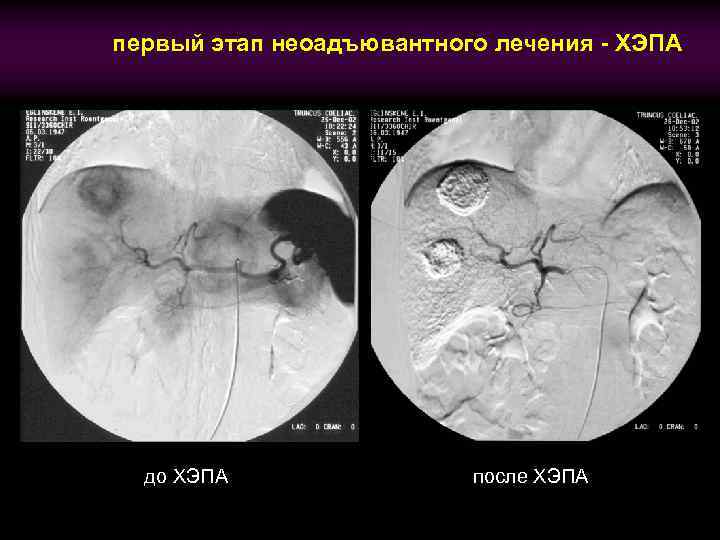 первый этап неоадъювантного лечения - ХЭПА до ХЭПА после ХЭПА 