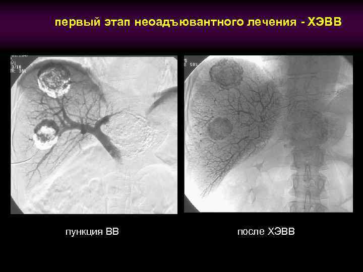 первый этап неоадъювантного лечения - ХЭВВ пункция ВВ после ХЭВВ 