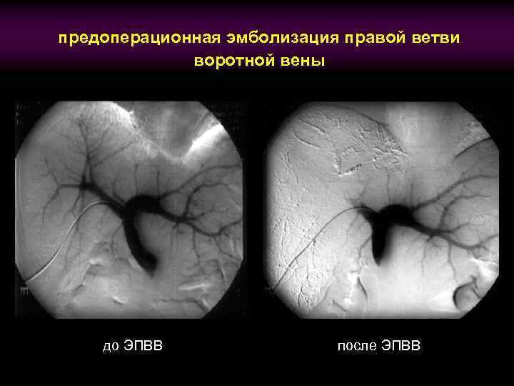 предоперационная эмболизация правой ветви воротной вены до ЭПВВ после ЭПВВ 