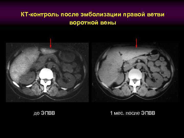 КТ-контроль после эмболизации правой ветви воротной вены до ЭПВВ 1 мес. после ЭПВВ 