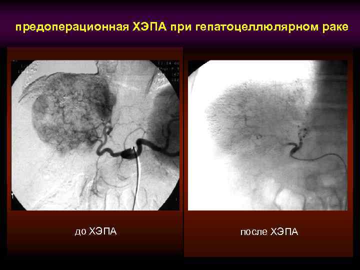 предоперационная ХЭПА при гепатоцеллюлярном раке до ХЭПА после ХЭПА 