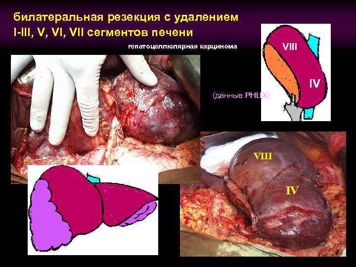 билатеральная резекция с удалением I-III, V, VII сегментов печени VIII гепатоцеллюлярная карцинома IV (данные