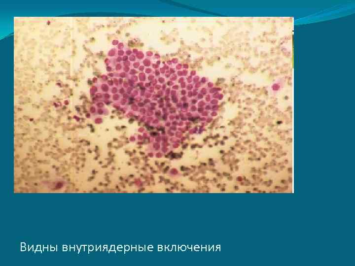 Видны внутриядерные включения 