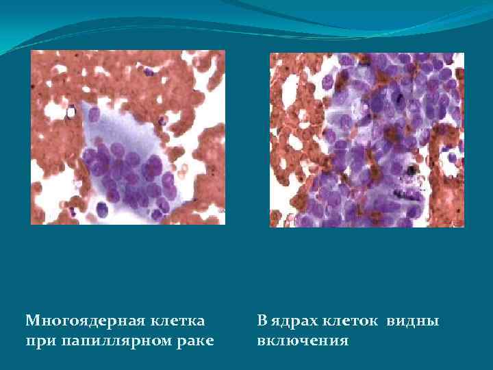 Многоядерная клетка при папиллярном раке В ядрах клеток видны включения 