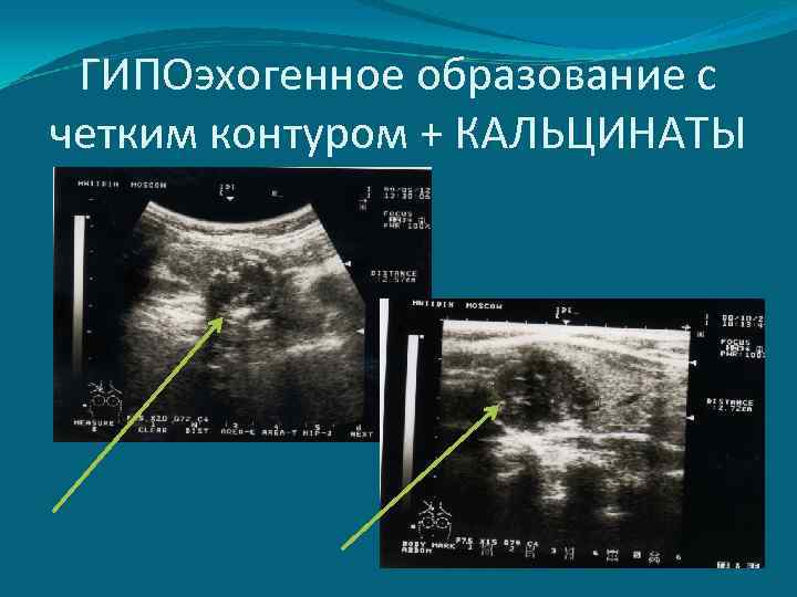 ГИПОэхогенное образование с четким контуром + КАЛЬЦИНАТЫ 