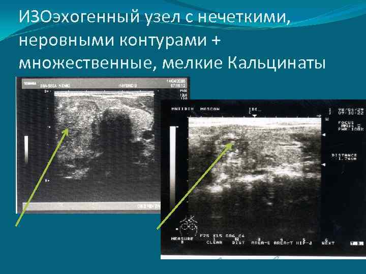ИЗОэхогенный узел с нечеткими, неровными контурами + множественные, мелкие Кальцинаты 