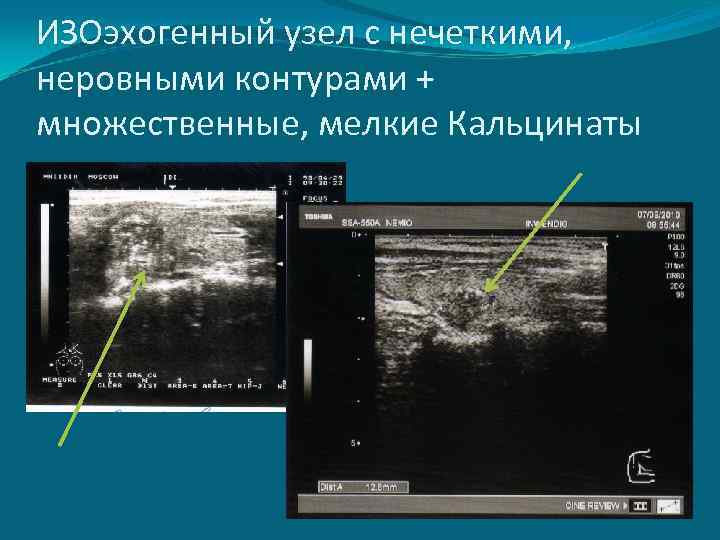 ИЗОэхогенный узел с нечеткими, неровными контурами + множественные, мелкие Кальцинаты 