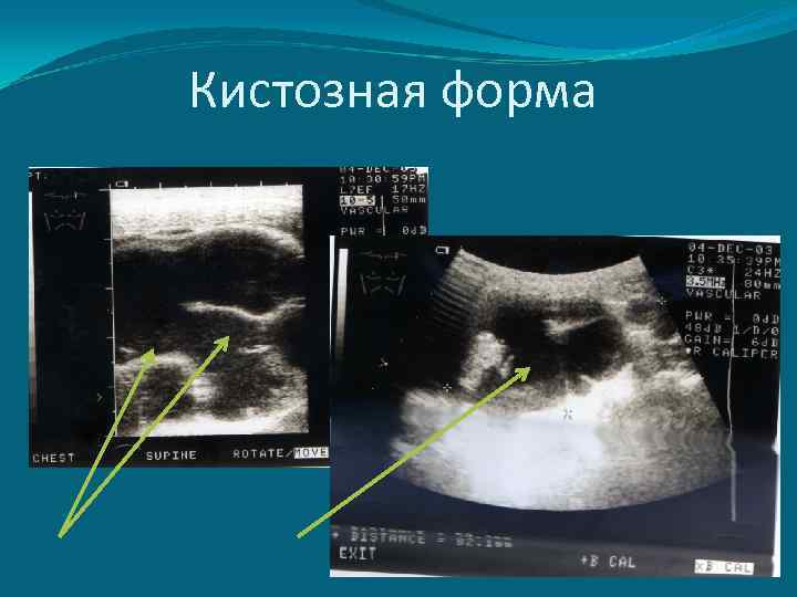 Кистозная форма 