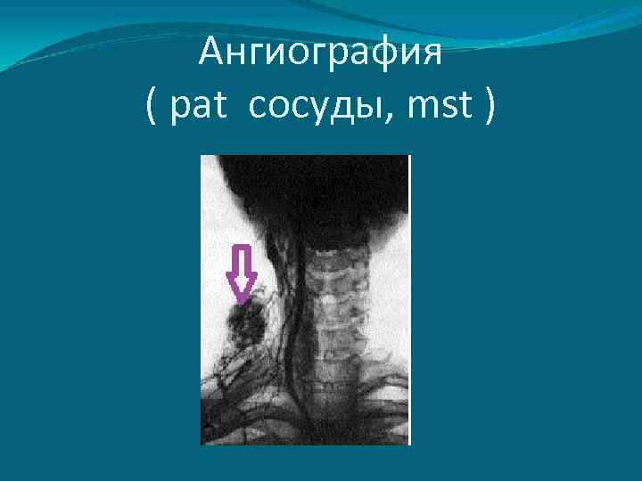 Ангиография ( pat сосуды, mst ) 