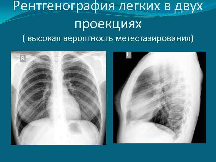 Рентгенография легких в двух проекциях ( высокая вероятность метестазирования) 