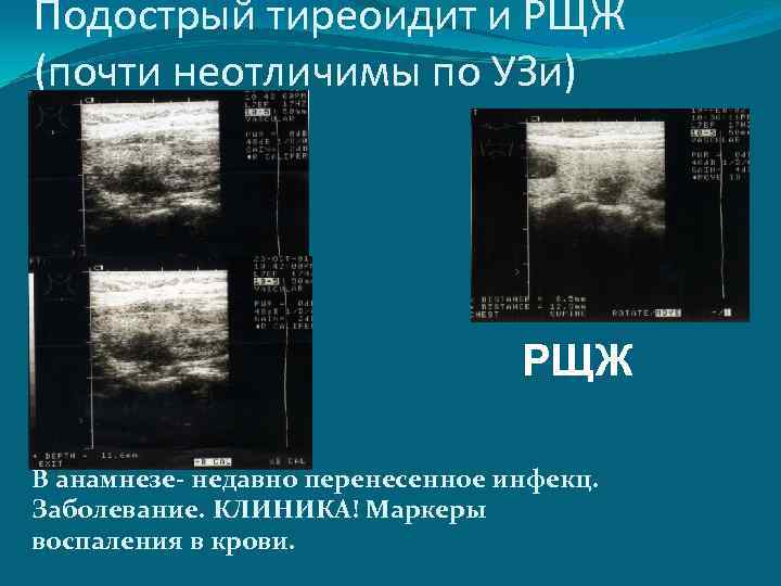 Подострый тиреоидит и РЩЖ (почти неотличимы по УЗи) РЩЖ В анамнезе- недавно перенесенное инфекц.