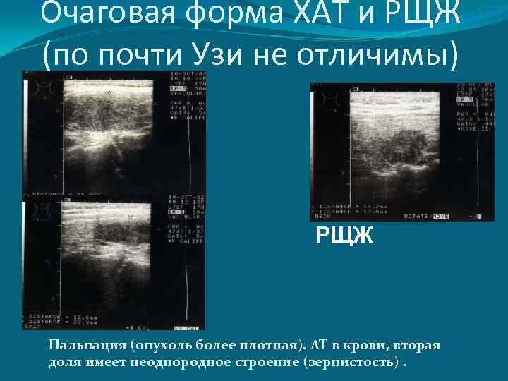 Очаговая форма ХАТ и РЩЖ (по почти Узи не отличимы) РЩЖ Пальпация (опухоль более